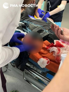 ЖЕСТКИЕ КАДРЫ! В Красногорске ребенок поднял с земли 10-рублевую купюру и ему разорвало кисть