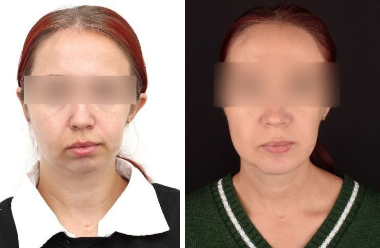 Красноярские хирурги впервые исправили врожденную асимметрию лица с помощью протеза
