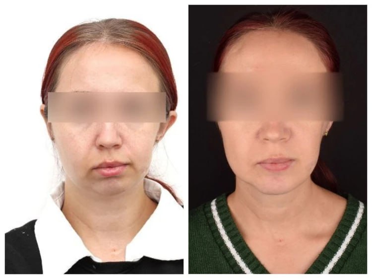 Красноярские хирурги провели уникальную операцию по коррекции врожденной аномалии лицевого скелета — у пациентки отсутствовал левый мыщелковый отросток