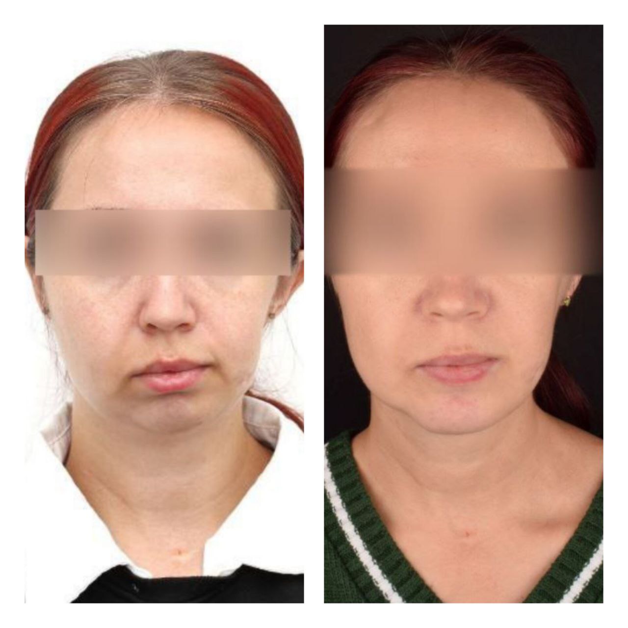 Красноярские хирурги провели операцию по коррекции врождённой аномалии лица Красноярские хирурги провели операцию по коррекции врождённой аномалии лица