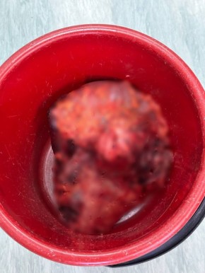 Опухоль размером с футбольный мяч удалили мужчине в Красноярске