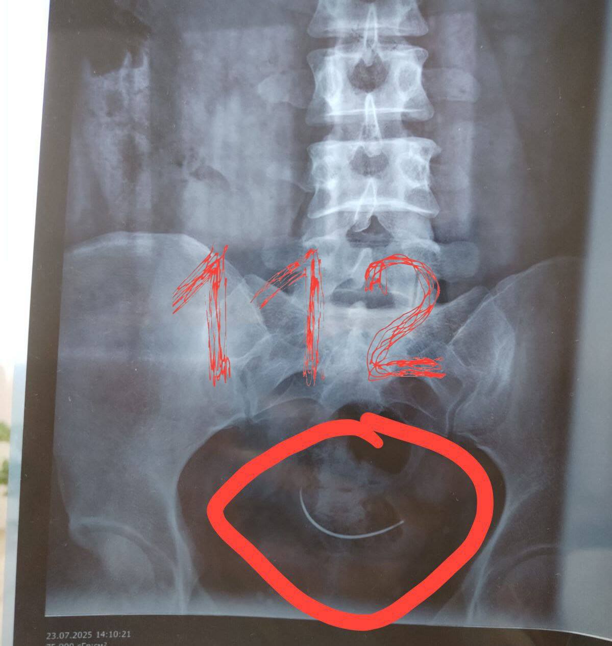 Жительнице Абакана предложили удалить иглу, которую врачи забыли внутри во время кесарева