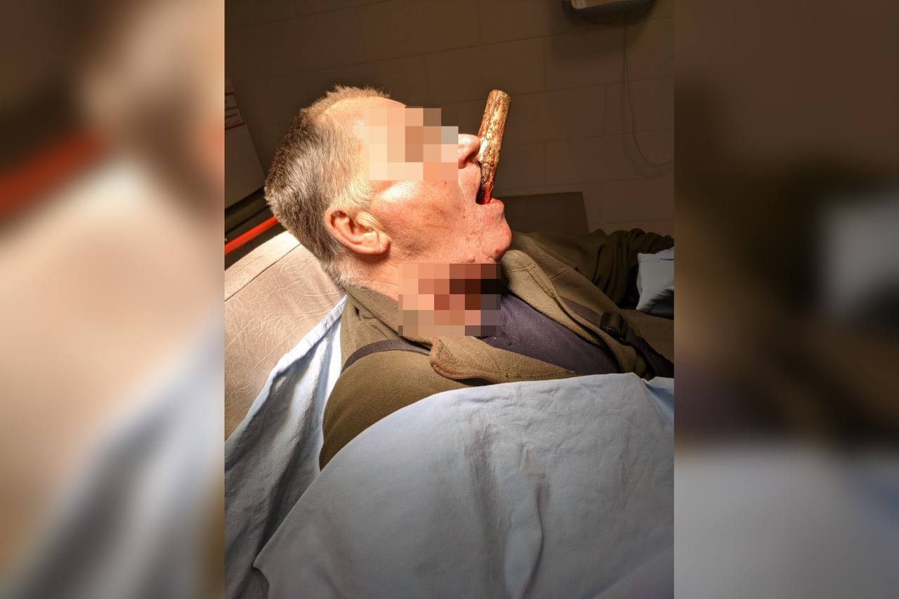 «Повезло, что он успел выбраться из тайги»: красноярские врачи спасли мужчину, которому в шею вонзился черенок от лопаты