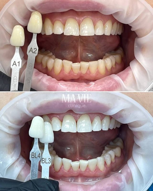 Налёт на зубах: Здоровье во рту под угрозой