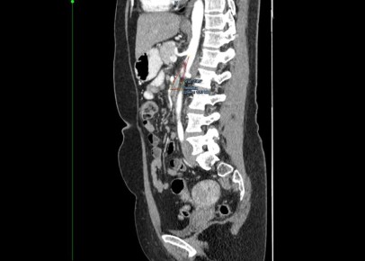 «Не могла нормально питаться»: хирурги прооперировали красноярку с редким заболеванием