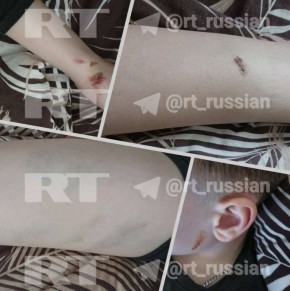 «У сына гематомы на руках, ногах, голове. Он плохо спит»