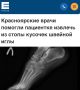 «Красноярские врачи помогли пациентке извлечь из стопы кусочек швейной иглы»: Жительница Красноярска несколько дней ходила и тренировалась с иголкой в стопе