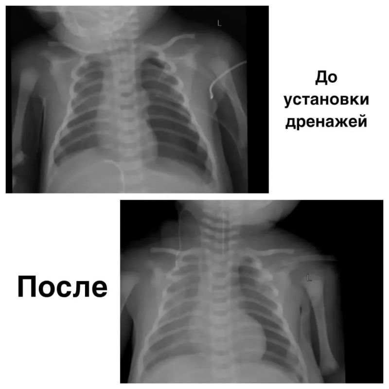 Красноярские врачи спасли новорождённого в критическом состоянии