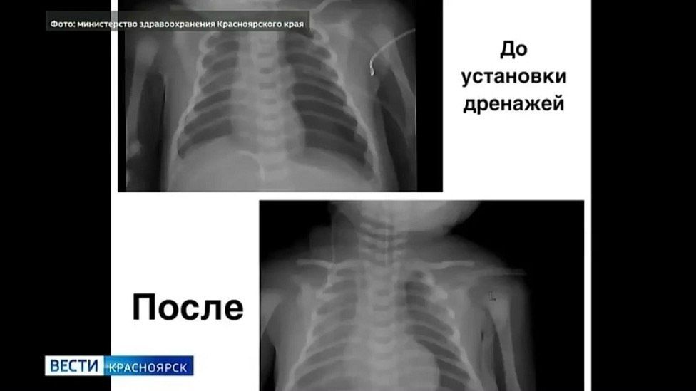 Красноярские врачи спасли новорождённого в критическом состоянии