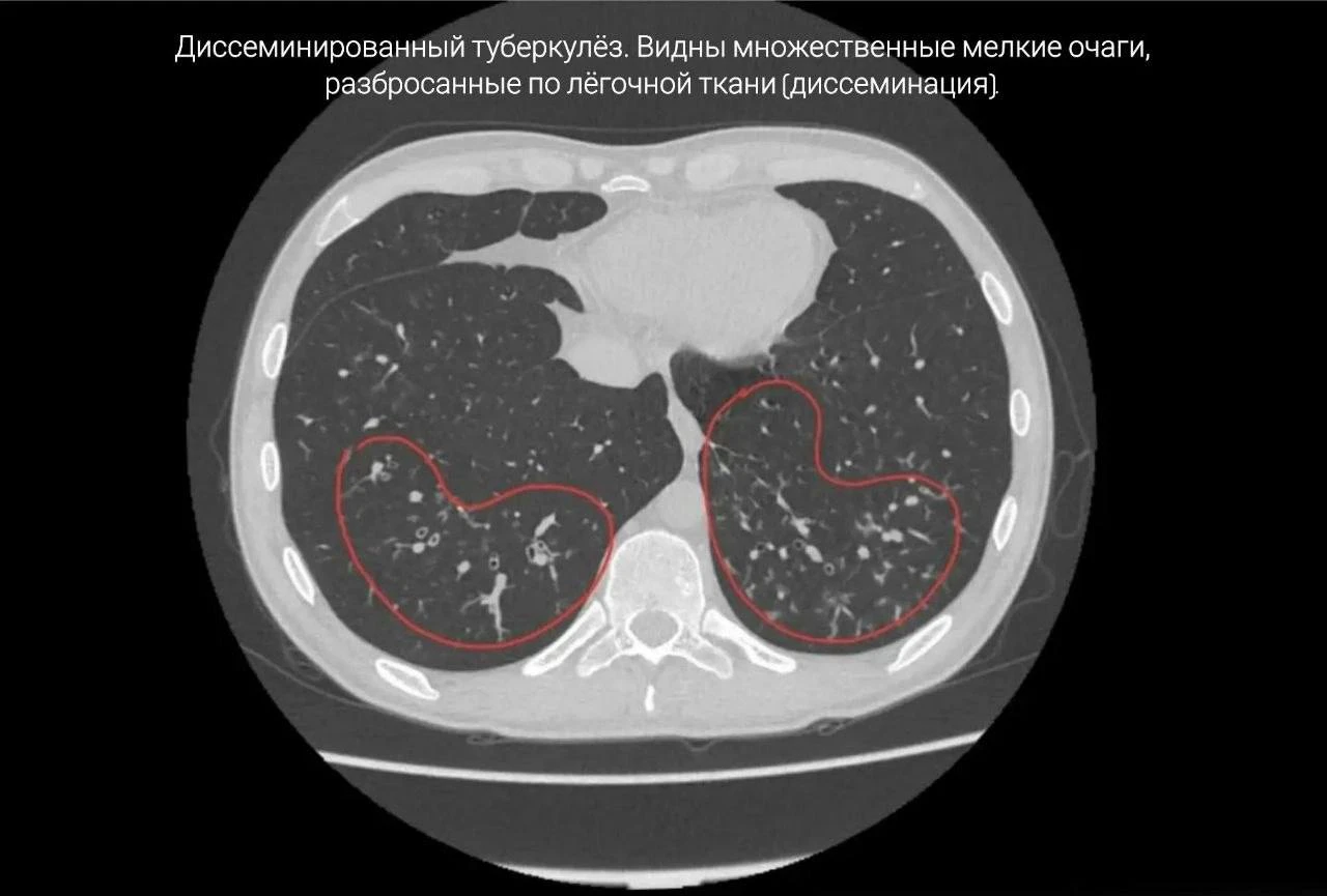 В Приморье умер 33-летний мужчина, который 17 лет курил вейпы