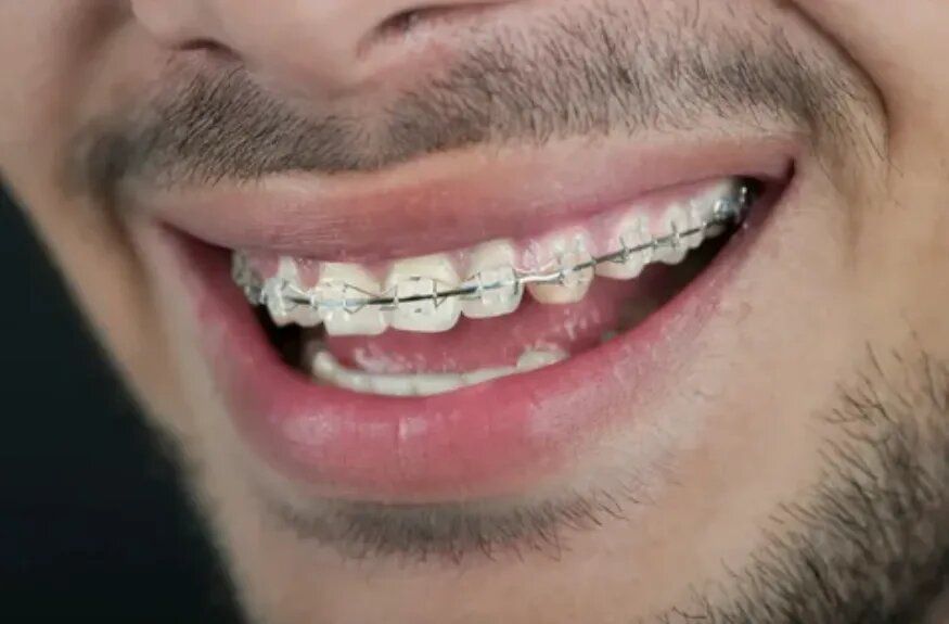 Брекеты и служба: как orthodontics влияют на призыв в армию